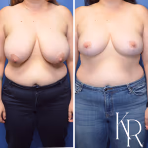 Breast reduction before and after photo, front view