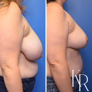 Breast reduction before and after photo, side view
