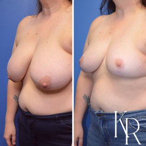 Breast reduction before and after photo, side view