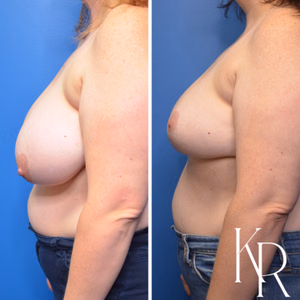 Breast reduction before and after photo, front view