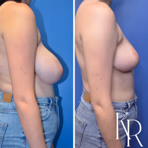 Breast reduction before and after photo, front view