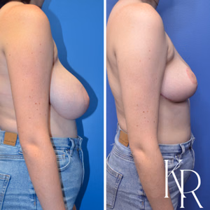 Breast reduction before and after photo, front view