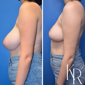 Breast reduction before and after photo, side view
