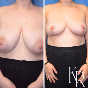 Breast reduction before and after photo, front view