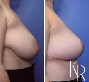 Breast reduction before and after photo, side view