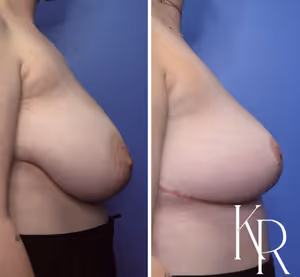 Breast reduction before and after photo, side view