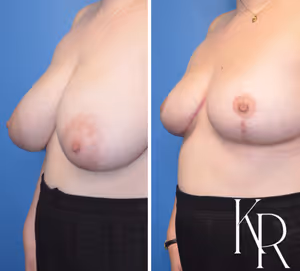 Breast reduction before and after photo, multiple views