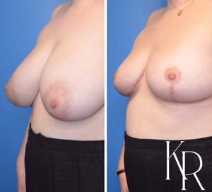 Breast reduction before and after photo, multiple views