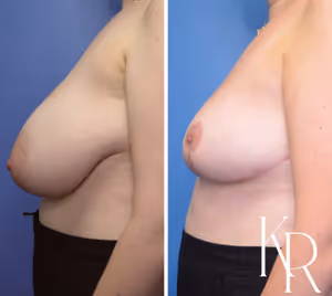 Breast reduction before and after photo, side view