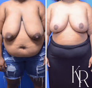 Breast reduction before and after photo, front view