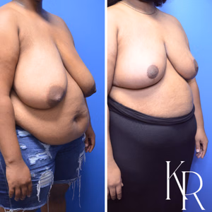 Breast reduction before and after photo, multiple views