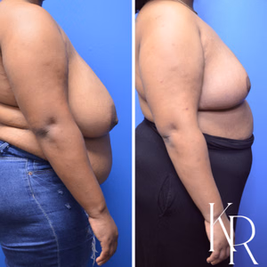 Breast reduction before and after photo, side view