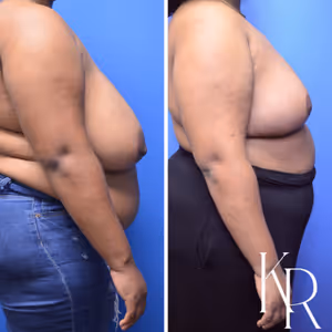 Breast reduction before and after photo, side view
