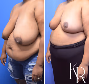 Breast reduction before and after photo, multiple views