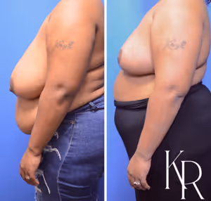Breast reduction before and after photo, side view