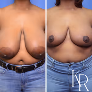 Breast reduction before and after photo, front view