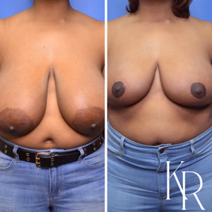Breast reduction before and after photo, front view