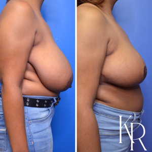 Breast reduction before and after photo, side view