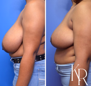 Breast reduction before and after photo, side view