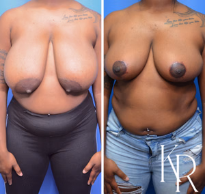 Breast reduction before and after photo, front view