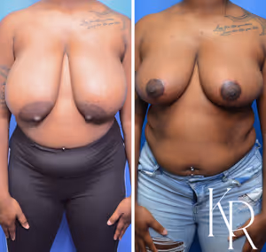 Breast reduction before and after photo, front view
