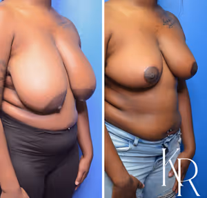 Breast reduction before and after photo, multiple views