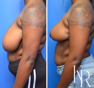 Breast reduction before and after photo, side view