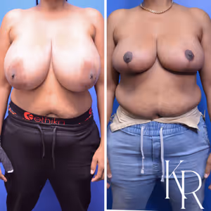 Breast reduction before and after photo, front view