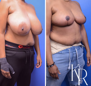 Breast reduction before and after photo, multiple views