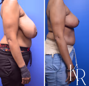 Breast reduction before and after photo, side view