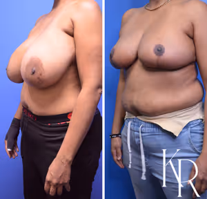Breast reduction before and after photo, multiple views