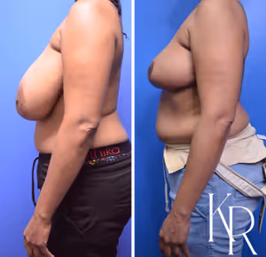 Breast reduction before and after photo, side view