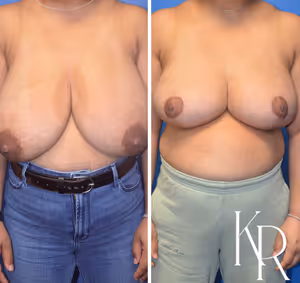 Breast reduction before and after photo, front view