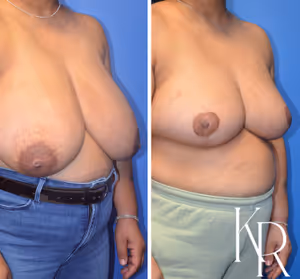 Breast reduction before and after photo, multiple views
