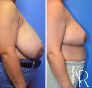 Breast reduction before and after photo, side view