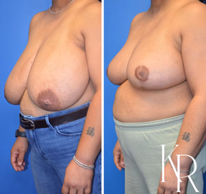 Breast reduction before and after photo, multiple views