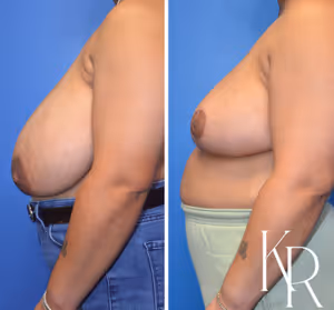 Breast reduction before and after photo, side view