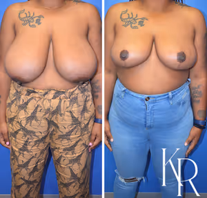 Breast reduction before and after photo, front view
