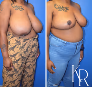 Breast reduction before and after photo, multiple views
