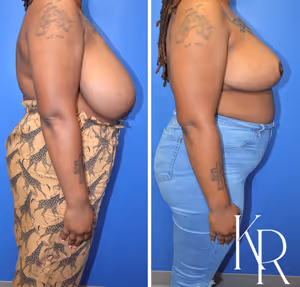 Breast reduction before and after photo, multiple views