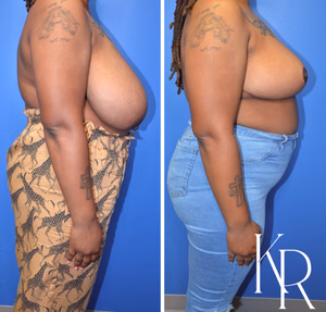 Breast reduction before and after photo, multiple views