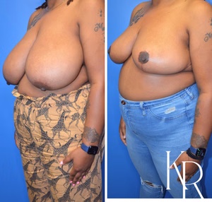 Breast reduction before and after photo, front view