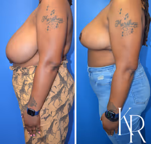 Breast reduction before and after photo, side view