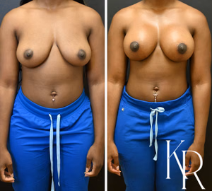 Breast lift with implants before and after photo, front view