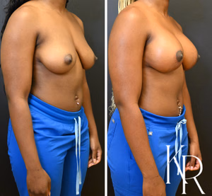 Breast lift with implants before and after photo, front view