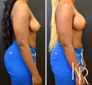 Breast lift with implants before and after photo, side view