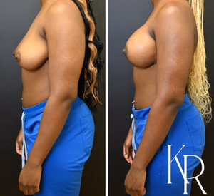 Breast lift with implants before and after photo, side view