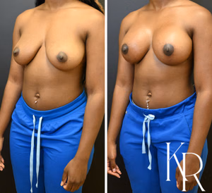 Breast lift with implants before and after photo, front view