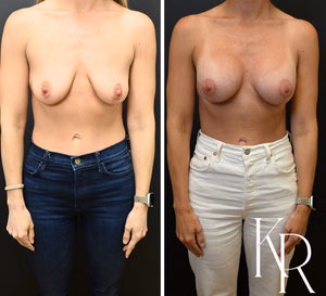 Breast lift with implants before and after photo, front view