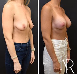 Breast lift with implants before and after photo, front view